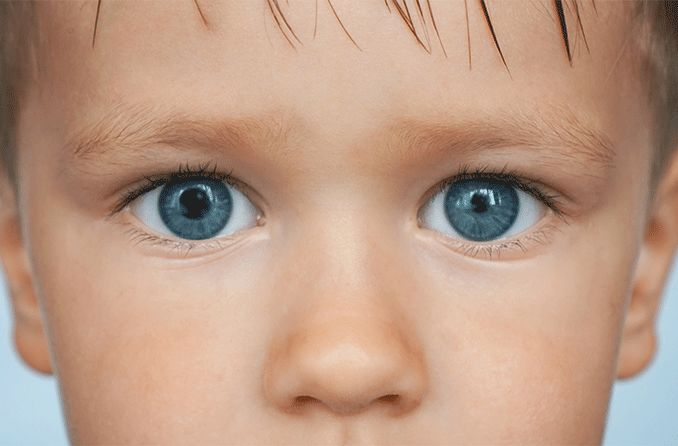 young boy with anisocoria