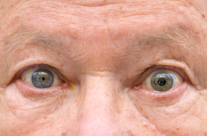 Photo depiction of a person with Marcus Gunn Pupil