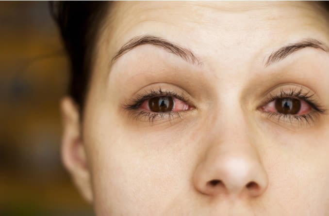 woman with pink eye