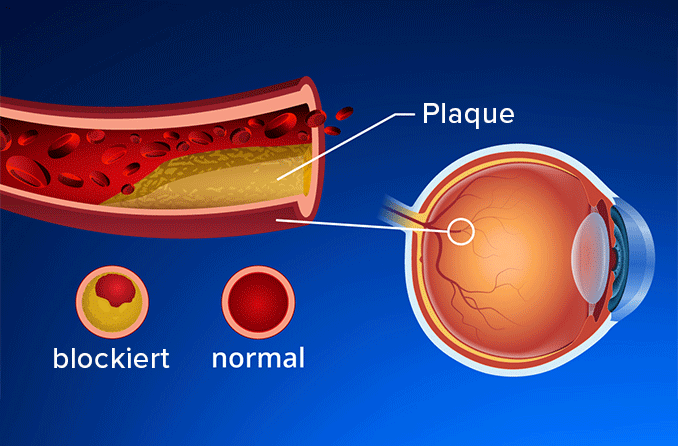 Augeninfarkte: RAV, VAV und andere retinale Arterien- und Venenverschlüsse
