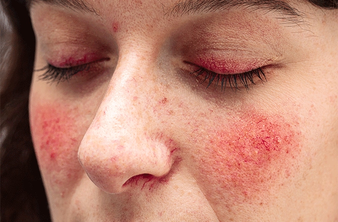 Frau mit Augenliddermatitis