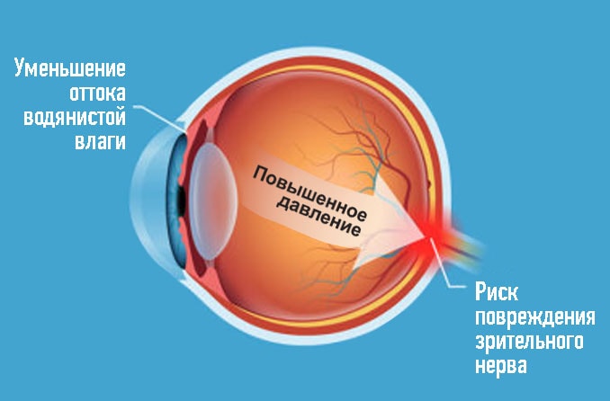 Диаграмма состояния глазной гипертензии
